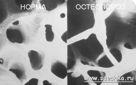 Что такое остеопороз, Факторы риска
